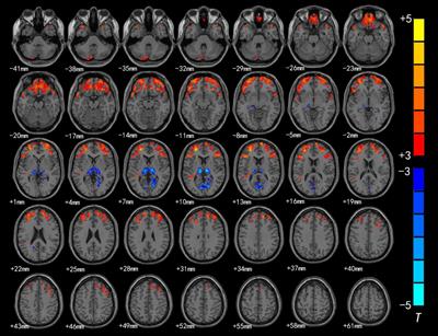 Cerebral cortex functional reorganization in preschool children with congenital sensorineural hearing loss: a resting-state fMRI study